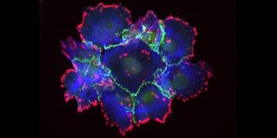 Mouse breast tumor cells. E-cadherin in green, vinculin in red, and actin in blue. Image credit: Weiyi Xu, Turner lab